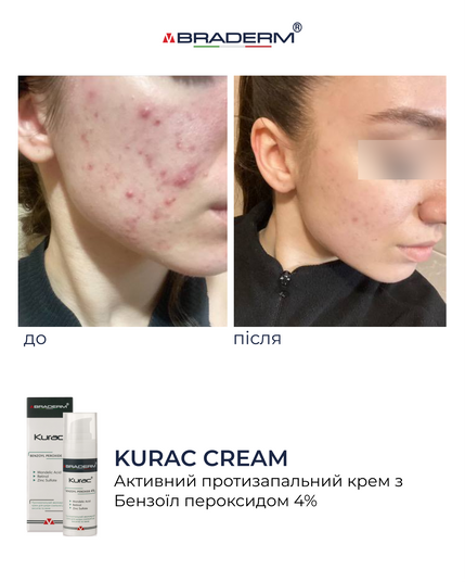 Курак крем - Активний протизапальний крем з бензоїл пероксидом 4