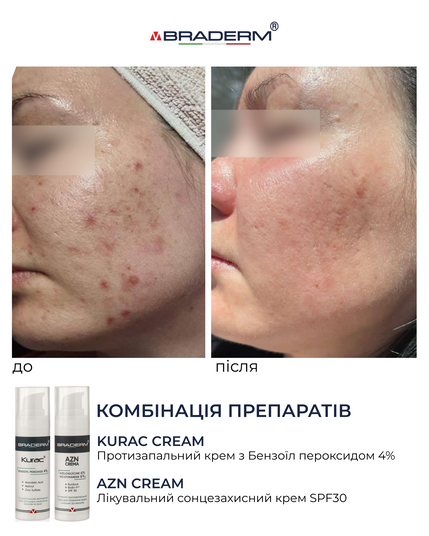 Курак крем - Активний протизапальний крем з бензоїл пероксидом 4