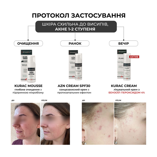 Курак крем - Активний протизапальний крем з бензоїл пероксидом 4